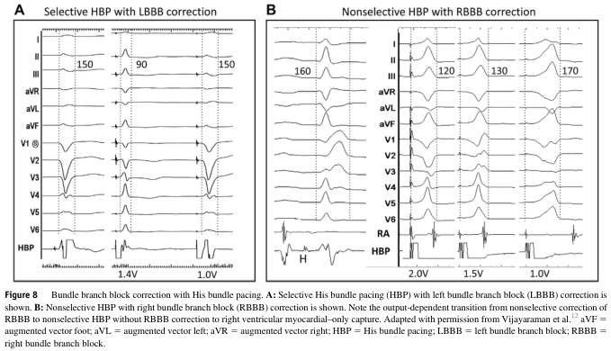 Summary : This figure presents two sets of 12-lead ECG tracings demonstrating bundle branch block correction using His bundle pacing (HBP). Panel A shows selective HBP with left bundle branch block (LBBB) correction, while Panel B shows nonselective HBP with right bundle branch block (RBBB) correction, including transitions at different pacing outputs.