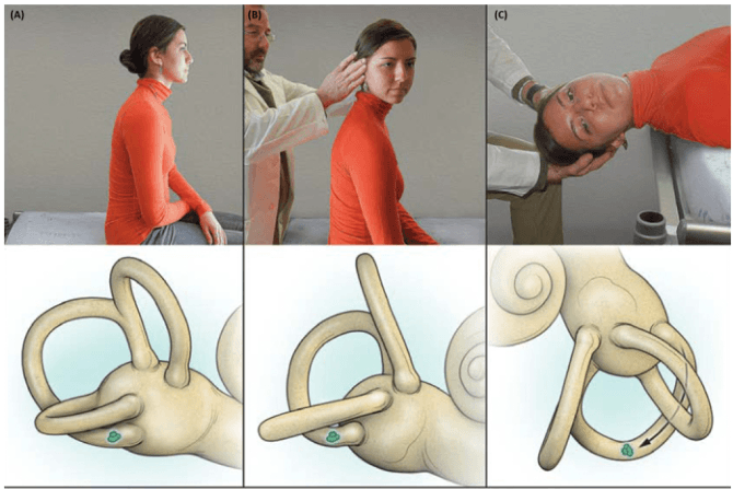 Summary : This figure demonstrates a clinical maneuver for repositioning otoliths in the inner ear, likely related to the treatment of benign paroxysmal positional vertigo (BPPV). The top row shows a sequence of photographs of a patient being guided through the maneuver, while the bottom row provides corresponding anatomical illustrations of the inner ear, highlighting the movement of otoliths.
photo and illustration:
# Scene Overview :
• Top row: Three sequential photographs of a patient in an orange shirt being guided by a clinician through a head movement maneuver.
• Bottom row: Three anatomical illustrations of the inner ear, each corresponding to the photograph above, showing the position and movement of otoliths (depicted as green shapes).
# Technical Details :
• No scale bars or magnification indicated.
• The anatomical illustrations focus on the semicircular canals and otoliths, with the cochlea visible in the third panel.
# Spatial Relationships :
• Left panel (A): Patient is seated upright, head in neutral position; otolith is located in the posterior semicircular canal.
• Middle panel (B): Patient’s head is turned 45 degrees to the right by the clinician; otolith remains in the canal.
• Right panel (C): Patient is laid back with head extended and rotated; otolith is shown moving through the canal toward the vestibule.
# Analysis :
• The sequence visually explains the steps of a canalith repositioning maneuver, likely the Epley maneuver, used to treat BPPV by moving displaced otoliths out of the semicircular canal and back into the vestibule.
• The anatomical illustrations clarify the intended movement of the otoliths during each step, supporting the clinical photographs.
• The figure effectively links clinical technique with underlying anatomical changes.