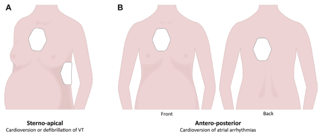 Summary : This figure illustrates the recommended pad placements for cardioversion or defibrillation in adult patients, with specific focus on sterno-apical and antero-posterior positions, and their clinical indications.
illustration:
# Pad Placement Methods :
## Panel A: Sterno-apical
• Shows a female torso (left side) with two defibrillator/cardioversion pads.
• One pad is placed on the upper right chest (sternal region).
• The other pad is placed on the left lateral chest (apical region).
• Labeled as "Sterno-apical".
• Indication: "Cardioversion or defibrillation of VT" (ventricular tachycardia).
## Panel B: Antero-posterior
• Shows a female torso from both front and back views.
• One pad is placed on the anterior chest (centered over the sternum).
• The other pad is placed on the back, directly behind the anterior pad (between the scapulae).
• Labeled as "Antero-posterior".
• Indication: "Cardioversion of atrial arrhythmias".
# Clinical Indications :
• Sterno-apical placement is recommended for cardioversion or defibrillation of ventricular tachycardia (VT).
• Antero-posterior placement is recommended for cardioversion of atrial arrhythmias.
# Design Elements :
• Simple, stylized anatomical illustrations of female torsos.
• Pads are depicted as white hexagons.
• Each panel is clearly labeled (A and B).
• Text annotations specify the clinical context for each pad placement.
# Analysis :
• The figure visually distinguishes between two common pad placements for electrical cardioversion/defibrillation, associating each with specific arrhythmia types.
• The sterno-apical position is lateral, while the antero-posterior position is aligned front-to-back.
• The use of both front and back views in panel B clarifies the spatial relationship of the antero-posterior pad placement.