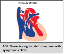 Summary : This illustration demonstrates the cardiac anatomy and blood flow in Tetralogy of Fallot (TOF), highlighting the right-to-left shunt characteristic of symptomatic TOF.
illustration:
# Scene Overview :
• Main subject: Diagram of the human heart showing abnormal blood flow in Tetralogy of Fallot.
• Perspective: Frontal cross-sectional view of the heart.
• Colour palette: Blue and red regions indicate deoxygenated and oxygenated blood, respectively.
• Key anatomical features: Right ventricle, left ventricle, aorta, pulmonary artery, and ventricular septal defect.
# Technical Details :
• On-image text: "Tetralogy of Fallot" at the top.
• Caption below: "TOF: Shown is a right-to-left shunt seen with symptomatic TOF."
• No scale bar or magnification indicated.
# Spatial Relationships :
• Blue (deoxygenated) blood flows from the right ventricle through a ventricular septal defect into the aorta, mixing with red (oxygenated) blood.
• The shunt direction is right-to-left, bypassing the pulmonary circulation.
# Analysis :
• The figure visually explains the pathophysiology of Tetralogy of Fallot, specifically the right-to-left shunt that leads to mixing of deoxygenated and oxygenated blood, a hallmark of symptomatic TOF.
• The abnormal flow pattern is clearly depicted, supporting the educational message in the caption.