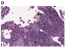 Summary : This image shows a histological section of tissue stained with hematoxylin and eosin (H&E), highlighting cellular and structural features under a microscope.
photo:
Scene Overview :
• Main subject is a dense cluster of small, round, darkly stained cells, typical of a high cellularity region in tissue.
• The image is taken from a microscope slide, with a field of view showing both compact and more loosely arranged areas.
• A white arrow points to a specific region of interest within the tissue, possibly indicating a pathological feature or area for attention.
• The background is mostly pale with some scattered cells and tissue fragments.
Technical Details :
• Staining: Hematoxylin and eosin (H&E), which imparts purple/blue coloration to nuclei and pink to cytoplasm/extracellular matrix.
• Magnification: Not specified, but typical for histology (likely 10x–40x objective).
• No visible scale bar or measurement units.
• No on-image UI elements or text except for the label "D" in the upper left corner.
Spatial Relationships :
• Dense cellular regions are concentrated in the lower and right portions of the image.
• Looser tissue and empty spaces (possibly alveolar or glandular structures) are present in the upper left and central areas.
• The arrow is centrally placed, pointing to a transition zone between dense and less dense tissue.
Analysis :
• The image highlights a region of tissue with marked cellularity, possibly indicative of inflammation, neoplasia, or other pathology.
• The arrow suggests a focus on a particular histological feature, such as a border between normal and abnormal tissue, or a diagnostic hallmark.
• The overall pattern shows heterogeneity in tissue architecture, with both compact and open areas.