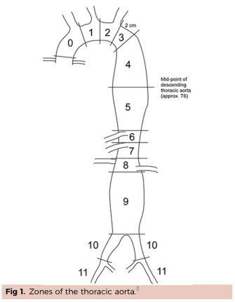 Summary : This illustration divides the thoracic aorta into anatomical zones, each labeled with a number from 0 to 11, to aid in clinical or surgical reference.
diagram:
# Zones of the Thoracic Aorta :
• The aorta is segmented into 12 zones, numbered 0 through 11.
• Zone 0: Proximal aortic arch.
• Zones 1–3: Ascending aorta and arch, with zone 3 ending 2 cm distal to the left subclavian artery.
• Zones 4–9: Descending thoracic aorta, with zone 4 starting after the arch and zone 9 ending before the bifurcation.
• Zones 10–11: Abdominal aorta and iliac arteries.
• The mid-point of the descending thoracic aorta is marked at approximately the T6 vertebral level.
• Brachiocephalic, left common carotid, and left subclavian arteries branch from the arch near zones 0–3.
# Annotations & Measurements :
• "2 cm" is marked at the distal end of zone 3.
• "Mid-point of descending thoracic aorta (approx. T6)" is labeled at zone 5.
• Zones 10 and 11 correspond to the iliac arteries.
# Layout :
• The zones are arranged sequentially from the aortic root (top left) through the arch, descending thoracic aorta, and into the abdominal aorta and iliac arteries.
• The diagram is a simplified line drawing, with each zone clearly demarcated by horizontal lines.
# Analysis :
• The figure provides a standardized anatomical reference for the thoracic and abdominal aorta, useful for describing the location of vascular pathology or interventions.
• The segmentation highlights key anatomical landmarks, such as the arch branches and the aortic bifurcation.
• The use of numbered zones facilitates precise communication in clinical and surgical contexts.