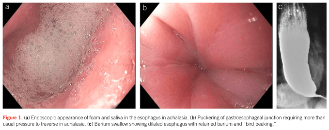 Summary : This figure presents three medical imaging views illustrating features of achalasia in the esophagus: endoscopic foam/saliva accumulation, puckering at the gastroesophageal junction, and a barium swallow radiograph showing classic "bird beak" appearance.
photo:
# Panel a: Endoscopic foam and saliva in achalasia
Scene Overview :
• Endoscopic view of the esophageal lumen.
• Significant accumulation of foam and saliva coating the mucosal surface.
• Pink mucosa visible beneath the frothy layer.
Technical Details :
• No scale bar or magnification indicated.
• Standard endoscopic lighting, no staining.
Spatial Relationships :
• Foam and saliva occupy the majority of the field, suggesting impaired clearance.
# Panel b: Puckering of gastroesophageal junction
Scene Overview :
• Endoscopic close-up of the gastroesophageal junction.
• Mucosa appears puckered and tightly closed.
• Pink, healthy-appearing tissue with visible folds.
Technical Details :
• No scale bar or magnification indicated.
• Standard endoscopic lighting.
Spatial Relationships :
• Junction is centrally located, with folds radiating outward.
# Panel c: Barium swallow radiograph ("bird beaking")
Scene Overview :
• Black-and-white radiograph of the thoracic region.
• Esophagus is dilated and filled with retained barium contrast.
• Distal esophagus tapers sharply, forming a "bird beak" shape.
Technical Details :
• No scale bar or magnification indicated.
• Barium contrast highlights the esophageal lumen.
Spatial Relationships :
• Dilated esophagus occupies the majority of the image, with tapering at the lower end.
Analysis :
• The images collectively demonstrate classic features of achalasia: impaired esophageal clearance (foam/saliva), resistance at the gastroesophageal junction (puckering), and radiographic evidence of esophageal dilation with distal narrowing ("bird beaking").
• These findings visually support the diagnosis and pathophysiology of achalasia, showing both functional and structural changes.