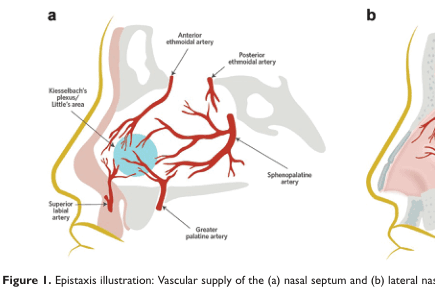 Summary : This illustration shows the vascular supply of the nasal septum, highlighting the main arteries involved in epistaxis (nosebleeds) and their anatomical locations.
illustration:
# Scene Overview :
• Main subject is the vascular anatomy of the nasal septum (left side of the nose in sagittal section).
• Perspective is a lateral cross-section, focusing on the internal nasal structures.
• Colour palette includes red for arteries, yellow for outline, and blue shading for a specific area (Kiesselbach’s plexus/Little’s area).
# Technical Details :
• No scale bar or magnification indicated.
• Anatomical labels are present for key arteries and regions.
# Spatial Relationships :
• The following arteries are labeled and shown branching within the nasal septum:
• Anterior ethmoidal artery (superior, anterior region)
• Posterior ethmoidal artery (superior, posterior region)
• Sphenopalatine artery (posterior, central region)
• Greater palatine artery (inferior, posterior region)
• Superior labial artery (inferior, anterior region)
• Kiesselbach’s plexus/Little’s area is highlighted in blue, located anteriorly on the septum, where several arteries converge.
# Analysis :
• The illustration emphasizes the convergence of multiple arteries at Kiesselbach’s plexus/Little’s area, a common site for anterior nosebleeds (epistaxis).
• The vascular supply is shown as dense and interconnected, especially in the anterior septal region, explaining the clinical significance of this area in nasal bleeding.
• The lateral nasal wall (panel b) is only partially visible and not labeled in this crop.