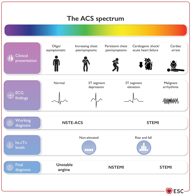 Summary : This figure illustrates the spectrum of Acute Coronary Syndromes (ACS), detailing the progression from mild or asymptomatic presentations to severe outcomes such as cardiac arrest. It organizes ACS into clinical presentation, ECG findings, working diagnosis, high-sensitivity cardiac troponin (hs-cTn) levels, and final diagnosis, showing how these elements interrelate across the ACS continuum.