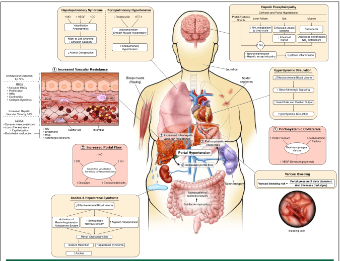 Summary : This is a comprehensive medical illustration summarizing the pathophysiology, clinical features, and complications of portal hypertension in liver disease, integrating vascular, hemodynamic, and systemic effects with annotated diagrams, flowcharts, and explanatory boxes.