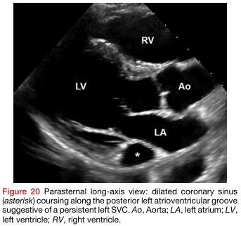 Summary : This figure is a parasternal long-axis echocardiographic view of the heart, highlighting a dilated coronary sinus (marked by an asterisk) in relation to the cardiac chambers and aorta, suggestive of a persistent left superior vena cava (SVC).
photo:
Scene Overview :
• Main subject: Echocardiographic image of the heart in the parasternal long-axis view.
• Key anatomical structures labeled: LV (left ventricle), RV (right ventricle), LA (left atrium), Ao (aorta), and a dilated coronary sinus (marked with an asterisk).
• The coronary sinus is seen coursing along the posterior left atrioventricular groove.
Technical Details :
• Imaging modality: Echocardiography (ultrasound).
• No scale bar or magnification indicated.
• Labels are overlaid directly on the image for anatomical reference.
Spatial Relationships :
• LV (left ventricle) is positioned centrally and to the left.
• RV (right ventricle) is superior and to the right.
• LA (left atrium) is inferior and to the right of the LV.
• Ao (aorta) is anterior to the LA and LV.
• The asterisk marks the dilated coronary sinus, located posterior to the LA.
Analysis :
• The image demonstrates a dilated coronary sinus, which is an abnormal finding and may indicate the presence of a persistent left SVC.
• The anatomical relationships between the cardiac chambers and great vessels are clearly visualized, aiding in the identification of the abnormal coronary sinus.