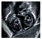 Summary : This image shows a labeled cross-sectional view of the heart, highlighting the anatomical positions of the aortic valve (Ao), mitral valve (MV), and tricuspid valve (TV).
photo:
Scene Overview :
• Main subject is a medical imaging scan (likely MRI or CT) of the heart in cross-section.
• The image is grayscale, with three key cardiac structures labeled: Ao (aortic valve), MV (mitral valve), and TV (tricuspid valve).
• The perspective is from above, looking down on the heart valves.
Technical Details :
• No scale bar or magnification is visible.
• Labels are overlaid directly on the image: "Ao", "MV", "TV".
• Imaging modality appears to be high-resolution, suitable for anatomical identification.
Spatial Relationships :
• Ao (aortic valve) is positioned centrally and slightly superior.
• MV (mitral valve) is to the right of Ao.
• TV (tricuspid valve) is to the left and slightly inferior to Ao.
• The valves are shown in close proximity, consistent with their anatomical arrangement in the heart.
Analysis :
• The image provides a clear anatomical reference for the location of the aortic, mitral, and tricuspid valves in a cross-sectional heart scan.
• Useful for educational or diagnostic purposes to identify valve positions and relationships.