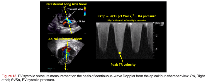 Summary : This figure demonstrates the measurement of right ventricular systolic pressure (RVSp) using continuous-wave Doppler echocardiography, specifically from the apical four-chamber view. It shows the anatomical views used to visualize the tricuspid regurgitation (TR) jet and the Doppler waveform used to calculate RVSp.
