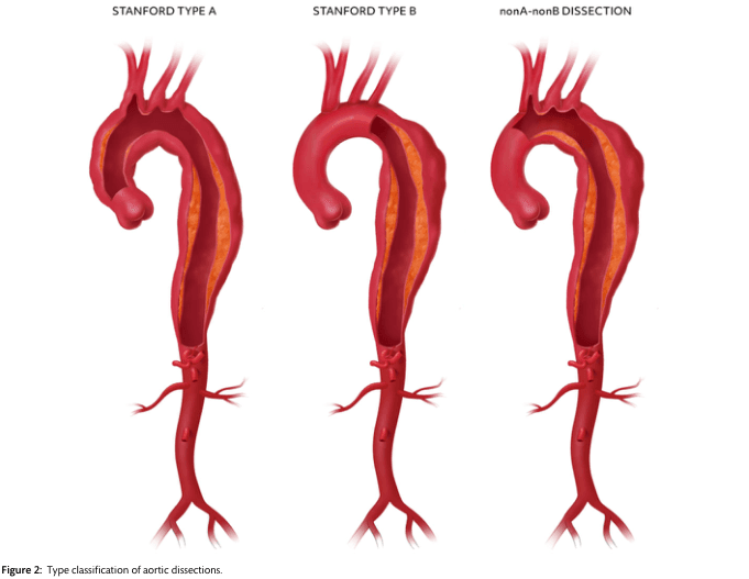 Summary : This figure illustrates the type classification of aortic dissections according to the Stanford system, showing three anatomical variants: Stanford Type A, Stanford Type B, and nonA-nonB dissection, with clear visualizations of the affected aortic segments.
illustration:
# Aortic Dissection Types :
• Three labeled anatomical diagrams of the aorta, each showing a different type of aortic dissection.
• Labels above each aorta: "STANFORD TYPE A", "STANFORD TYPE B", and "nonA-nonB DISSECTION".
## Stanford Type A :
• Dissection involves the ascending aorta and extends beyond the aortic arch.
• The false lumen (depicted as a split in the aortic wall) is present from the ascending aorta through the arch and into the descending aorta.
## Stanford Type B :
• Dissection starts distal to the left subclavian artery, involving only the descending aorta.
• The ascending aorta and arch are not involved.
## nonA-nonB Dissection :
• Dissection involves the aortic arch but does not extend into the ascending aorta.
• The false lumen is present in the arch and descending aorta, sparing the ascending aorta.
# Scene Overview :
• All diagrams are oriented with the aortic root at the top and the abdominal aorta at the bottom.
• The aortic branches (brachiocephalic, left common carotid, left subclavian) are visible at the top of each diagram.
• The false lumen is shown as a darker inner channel within the aortic wall.
# Technical Details :
• No scale bar or magnification is provided.
• The diagrams use red and orange hues to differentiate the true and false lumens.
# Spatial Relationships :
• The three diagrams are aligned side-by-side for direct comparison.
• The extent and location of the dissection vary between the types, highlighting the anatomical differences.
# Analysis :
• The figure visually distinguishes the three main anatomical patterns of aortic dissection.
• Stanford Type A involves the ascending aorta, Stanford Type B is limited to the descending aorta, and nonA-nonB involves the arch without the ascending aorta.
• This classification is critical for clinical decision-making and management of aortic dissections.