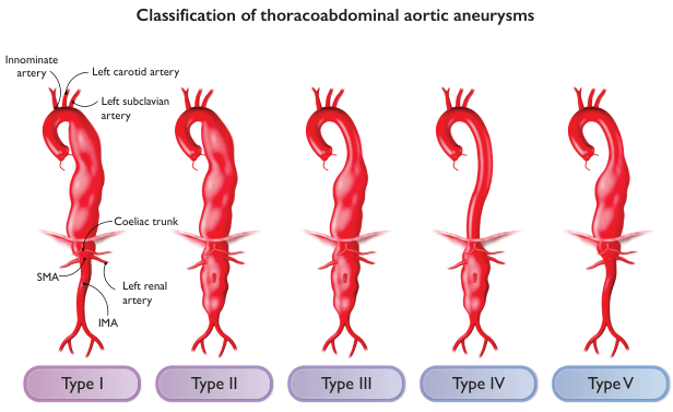 Summary : This figure illustrates the classification of thoracoabdominal aortic aneurysms into five types (I–V), showing the anatomical extent of each type along the aorta and its major branches.