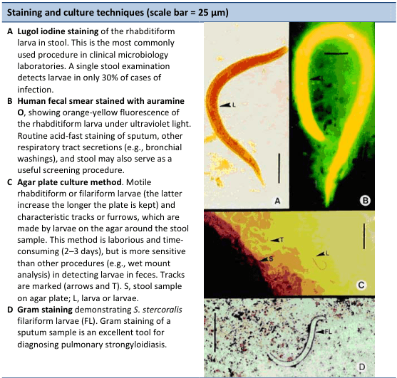 Summary : This figure presents four laboratory techniques for detecting Strongyloides stercoralis larvae in clinical samples, with corresponding micrographs illustrating each method. The scale bar in all images is 25 µm.