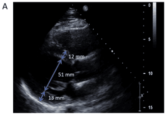 Summary : This image shows a cardiac ultrasound (echocardiogram) with three key measurements annotated in millimeters, likely assessing heart chamber dimensions and wall thickness.
photo:
Scene Overview :
• Main subject is a grayscale echocardiogram image of the heart, oriented in a standard parasternal long-axis view.
• The image is annotated with three blue double-headed arrows indicating measured distances within the heart.
• The measurements are labeled as 12 mm, 51 mm, and 13 mm.
Technical Details :
• Imaging modality: ultrasound (echocardiography).
• Measurement arrows:
– 12 mm: likely represents anterior wall thickness or chamber dimension.
– 51 mm: likely represents the left ventricular internal diameter.
– 13 mm: likely represents posterior wall thickness or another chamber dimension.
• Right side of the image includes a vertical scale (0 to 15), possibly depth in centimeters.
• No scale bar, but measurements are directly annotated.
Spatial Relationships :
• The 12 mm and 13 mm arrows are perpendicular to the long axis of the ventricle, suggesting wall thickness measurements.
• The 51 mm arrow spans the largest distance, likely across the left ventricle.
• All measurements are taken at approximately the same depth within the image.
Analysis :
• The image provides quantitative assessment of cardiac structure, with clear visualization of chamber size and wall thickness.
• The measured values (12 mm, 51 mm, 13 mm) are typical for evaluating cardiac function and morphology.
• No obvious abnormalities or anomalies are visible in the measured regions; the heart structures appear well-defined.