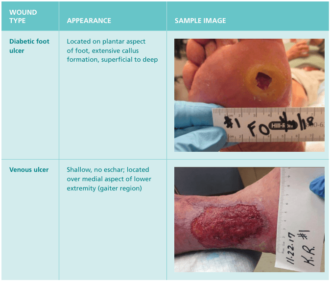Summary : This figure presents a comparative visual and descriptive overview of two types of chronic wounds: diabetic foot ulcer and venous ulcer, including their typical appearance and photographic examples.