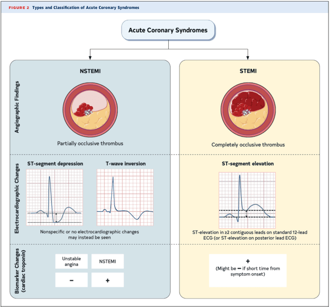 Summary : This figure presents the types and classification of Acute Coronary Syndromes, contrasting NSTEMI (Non-ST-Elevation Myocardial Infarction) and STEMI (ST-Elevation Myocardial Infarction) based on angiographic findings, electrocardiographic changes, and cardiac biomarker changes.
flowchart:
# Main Categories :
• Acute Coronary Syndromes (central node)
– Branches into: NSTEMI (left), STEMI (right)
# NSTEMI :
## Angiographic Findings :
• Illustration of a coronary artery with a partially occlusive thrombus.
• Label: "Partially occlusive thrombus"
## Electrocardiographic Changes :
• ST-segment depression (example ECG tracing)
• T-wave inversion (example ECG tracing)
• Note: "Nonspecific or no electrocardiographic changes may instead be seen"
## Biomarker Change (cardiac troponin) :
• Unstable angina: negative (–)
• NSTEMI: positive (+)
# STEMI :
## Angiographic Findings :
• Illustration of a coronary artery with a completely occlusive thrombus.
• Label: "Completely occlusive thrombus"
## Electrocardiographic Changes :
• ST-segment elevation (example ECG tracing)
• Note: "ST-elevation in ≥2 contiguous leads on standard 12-lead ECG (or ST-elevation on posterior lead ECG)"
## Biomarker Change (cardiac troponin) :
• Positive (+)
• Note: "Might be – if short time from symptom onset"
# Layout :
• Two-column comparison: NSTEMI (blue background, left), STEMI (yellow background, right)
• Each column subdivided into three horizontal sections: Angiographic Findings, Electrocardiographic Changes, Biomarker Change
# Analysis :
• NSTEMI is characterized by partial thrombus occlusion, ST-segment depression or T-wave inversion (or nonspecific ECG changes), and positive cardiac troponin.
• STEMI is defined by complete thrombus occlusion, ST-segment elevation on ECG, and positive cardiac troponin (may be negative early after symptom onset).
• The figure visually distinguishes the pathophysiology, ECG findings, and biomarker profiles of NSTEMI and STEMI, aiding in clinical differentiation.