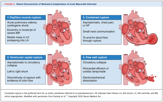 Summary : This figure presents the clinical characteristics and visual depictions of four major mechanical complications that can occur after an acute myocardial infarction: papillary muscle rupture, ventricular septal rupture, contained rupture, and free wall rupture. Each complication is described with its clinical presentation and key diagnostic features.
illustration:
# Mechanical Complications of Acute Myocardial Infarction :
## 1. Papillary muscle rupture :
• Acute pulmonary edema; cardiogenic shock.
• Eccentric or broad jet of severe mitral regurgitation (MR).
• Mobile mass in left ventricle (LV); prolapsing into left atrium (LA).
• Illustration shows a ruptured papillary muscle with regurgitant flow from LV to LA.
## 2. Ventricular septal rupture :
• Ranges from asymptomatic to circulatory collapse.
• Left to right shunt.
• Discontinuity of septum with evidence of color flow.
• Illustration depicts a defect in the interventricular septum with abnormal blood flow between ventricles.
## 3. Contained rupture :
• May be asymptomatic, or present with chest pain or heart failure (HF).
• Small neck communication.
• To-and-fro blood flow through rupture.
• Illustration shows a localized rupture with a small communication and limited blood leakage.
## 4. Free wall rupture :
• Circulatory collapse.
• Pericardial effusion or cardiac tamponade.
• Electromechanical dissociation.
• Illustration depicts a rupture of the ventricular free wall with blood escaping into the pericardial space.
# Additional Notes :
• Contained rupture is the preferred term for what is sometimes called a pseudoaneurysm.
• Abbreviations: HF = heart failure; LA = left atrium; LV = left ventricle; MR = mitral regurgitation.
# Analysis :
• The figure visually and textually distinguishes the four main mechanical complications post-myocardial infarction, highlighting their clinical presentations and pathophysiological features.
• Papillary muscle and septal ruptures primarily affect intracardiac flow, while contained and free wall ruptures involve the cardiac wall and pericardium, with free wall rupture being the most catastrophic.
• The illustrations reinforce the anatomical sites and consequences of each complication, aiding in rapid clinical recognition.