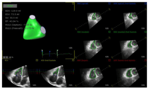Summary : This figure presents a multi-panel echocardiographic analysis of the right ventricle, including 3D modeling, quantitative measurements, and multiple ultrasound image slices at different cardiac phases.
photo (echocardiography analysis) :
# Scene Overview :
• Main subject is a composite echocardiography report showing right ventricular (RV) function.
• Central 3D model of the RV (green) with labeled regions.
• Multiple ultrasound image slices (grayscale) of the heart in different views and time points.
• Overlaid colored contours and measurement lines on ultrasound images.
• ECG trace shown below the 3D model, synchronized with image frames.
# Technical Details :
• Quantitative measurements listed (left side):
– EDV: 128.0 ml
– ESV: 73.5 ml
– SV: 55.1 ml
– EF: 43.0 %
– RVLS (Septum): -8.7 %
– RVLS (Freewall): -16.7 %
• 3D model highlights septal and freewall regions.
• Image panels labeled with cardiac phase (e.g., End Systole, End Diastole).
• Color-coded overlays (green, yellow, red) on ultrasound images indicate tracked myocardial regions.
• ECG trace with markers for cardiac cycle timing.
# Spatial Relationships :
• 3D model and measurements on the left; ultrasound image panels arranged in a grid on the right.
• Each ultrasound panel corresponds to a specific cardiac phase and anatomical slice.
• ECG trace aligns temporally with image frames.
# Analysis :
• The figure provides a comprehensive visual and quantitative assessment of right ventricular function, including volumetric and strain measurements.
• The 3D model and color overlays facilitate regional analysis of RV motion.
• The arrangement allows for temporal and spatial correlation between cardiac cycle, anatomy, and function.