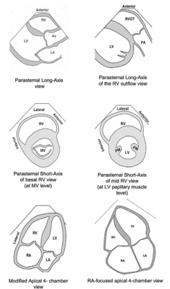Summary : This figure presents six schematic diagrams of standard echocardiographic views used to visualize the heart chambers and valves, specifically focusing on the right ventricle (RV) and its relationship to other cardiac structures.
illustration:
# Views Presented :
• Parasternal Long-Axis view: Shows RV, Ao (aorta), and LA (left atrium) in a longitudinal section.
• Parasternal Long-Axis of the RV outflow view: Displays RVOT (right ventricular outflow tract), PA (pulmonary artery), and LV (left ventricle).
• Parasternal Short-Axis of basal RV view (at MV level): Cross-sectional view at the mitral valve (MV) level, showing RV and MV.
• Parasternal Short-Axis of mid RV view (at LV papillary muscle level): Cross-sectional view at the level of the LV papillary muscles, showing RV, LV, and papillary muscles (PM).
• Modified Apical 4-chamber view: Displays RA (right atrium), RV, LA, and LV in a four-chamber perspective.
• RA-focused apical 4-chamber view: Focuses on RA, RV, LA, and LV, emphasizing the right atrium.
# Labels & Orientation :
• Each diagram is labeled with anatomical structures (RV, LV, LA, RA, Ao, PA, MV, PM).
• Orientation markers such as "Anterior," "Lateral," and "Septal" are provided for spatial reference.
# Design Encodings :
• Simple black-and-white line drawings.
• Chamber walls and valves are outlined; no colour or shading.
• Each view is titled below the corresponding diagram.
# Analysis :
• The figure systematically compares different echocardiographic views, highlighting how the right ventricle and associated structures appear in each orientation.
• The progression from long-axis to short-axis and apical views demonstrates the versatility of echocardiography in assessing cardiac anatomy and function.
• The inclusion of both standard and modified views allows for comprehensive visualization of the right heart.