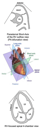 Summary : This figure illustrates anatomical and echocardiographic planes and views of the heart, focusing on the right ventricle (RV) and its outflow tract, as well as the relationship between imaging planes and cardiac anatomy.
illustration:
# Anatomical Diagrams :
• Top diagram: Schematic cross-section showing the anterior heart with the right ventricular outflow tract (RVOT), aorta (Ao), and pulmonary artery (PA) labeled.
• Bottom diagram: Schematic of a four-chamber heart view, labeling the right ventricle (RV), left ventricle (LV), right atrium (RA), and left atrium (LA), with lateral orientation indicated.
# Echocardiographic Planes :
• Central image: 3D anatomical heart model with three intersecting planes labeled:
– Long axis plane (blue)
– Short axis plane (green)
– Apical plane (purple)
• Directions labeled: Superior, Inferior, Anterior, Posterior, Medial, Lateral.
# View Labels :
• Middle annotation: "Parasternal Short-Axis of the RV outflow view (PA bifurcation view)" indicating the imaging plane for visualizing the pulmonary artery bifurcation.
• Bottom annotation: "RV-focused apical 4-chamber view" indicating the imaging plane for visualizing all four heart chambers with emphasis on the right ventricle.
# Analysis :
• The figure demonstrates how different echocardiographic planes intersect the heart to provide specific anatomical views, aiding in the assessment of right ventricular structure and function. The schematic diagrams clarify the orientation and anatomical relationships for each view, supporting accurate imaging and interpretation in clinical practice.