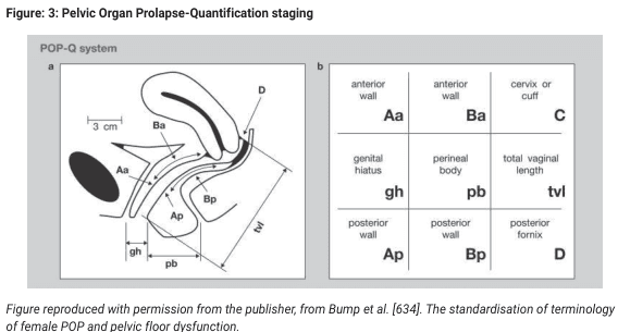 Summary : This figure illustrates the Pelvic Organ Prolapse Quantification (POP-Q) system, which is used for staging and standardizing the assessment of pelvic organ prolapse in women. It includes both an anatomical diagram and a terminology grid for reference points used in the POP-Q system.
illustration:
# POP-Q System Diagram :
• Sagittal anatomical illustration of the female pelvis showing the vagina, bladder, and rectum.
• Key reference points are labeled: Aa, Ba, Ap, Bp, C, D, gh, pb, tvl.
• Measurements such as "3 cm" and distances for genital hiatus (gh) and perineal body (pb) are indicated with double-headed arrows.
• The diagram visually demonstrates where each POP-Q point is located along the vaginal walls and perineal structures.
# POP-Q Terminology Grid :
• 3x3 grid listing anatomical reference points and their abbreviations:
– Anterior wall: Aa, Ba
– Cervix or cuff: C
– Genital hiatus: gh
– Perineal body: pb
– Total vaginal length: tvl
– Posterior wall: Ap, Bp
– Posterior fornix: D
• Each cell contains the abbreviation and the corresponding anatomical term.
# Technical Details :
• Figure is adapted from Bump et al., referencing the standardization of terminology for female pelvic organ prolapse and pelvic floor dysfunction.
• No scale bar, but a 3 cm reference is shown for anatomical context.
# Spatial Relationships :
• The anatomical diagram is oriented in the sagittal plane, with the anterior wall (bladder side) on the left and the posterior wall (rectum side) on the right.
• The grid provides a cross-reference for the anatomical points shown in the diagram.
# Analysis :
• The figure provides a comprehensive visual guide to the POP-Q system, clarifying the location and terminology of key reference points used in clinical staging of pelvic organ prolapse.
• The combination of diagram and grid supports both anatomical understanding and standardized clinical communication.