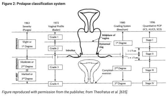 Summary : This figure presents a comparative overview of four prolapse classification systems used between 1963 and 1996, mapping their grading criteria onto anatomical diagrams of vaginal prolapse severity, and aligning terminology and measurement thresholds across systems.
diagram:
# Prolapse Classification Systems Overview :
• Four classification systems are compared: 1963 Severity (Porges), 1972 Vaginal Profile (Baden), 1980 Grading System (Beecham), and 1996 Quantitative POP (ICS, AUGS, SGS).
• The systems are aligned horizontally, with anatomical diagrams in the center showing prolapse positions relative to the midplane of the vagina, hymeneal ring, and introitus.
## 1963 Severity (Porges) :
• Slight or 1st Degree
• Moderate or 2nd Degree
• Marked or 3rd Degree
## 1972 Vaginal Profile (Baden) :
• Grade 1
• Grade 2
• Grade 3
• Grade 4
## 1980 Grading System (Beecham) :
• 1st Degree (above hymeneal ring)
• 2nd Degree (to or through hymeneal ring)
• 3rd Degree (complete eversion)
## 1996 Quantitative POP (ICS, AUGS, SGS) :
• Stage I (−1 cm)
• Stage II (between −1 cm and +1 cm)
• Stage III (beyond +1 cm)
• Stage IV (complete eversion)
# Anatomical Reference Points :
• Midplane of vagina
• Hymeneal ring
• Introitus
• Complete eversion (dotted outline)
# Mapping and Correspondence :
• Each system’s grades are mapped to anatomical positions and to each other.
• The diagram shows prolapse progression from slight descent (above hymeneal ring) to complete eversion (beyond introitus).
# Analysis :
• The figure visually aligns historical and modern prolapse grading systems, clarifying how each system’s terminology and thresholds correspond anatomically.
• The 1996 system introduces quantitative measurements (in centimeters) for more precise staging.
• All systems recognize a spectrum from mild descent to complete eversion, but differ in terminology and anatomical reference points.