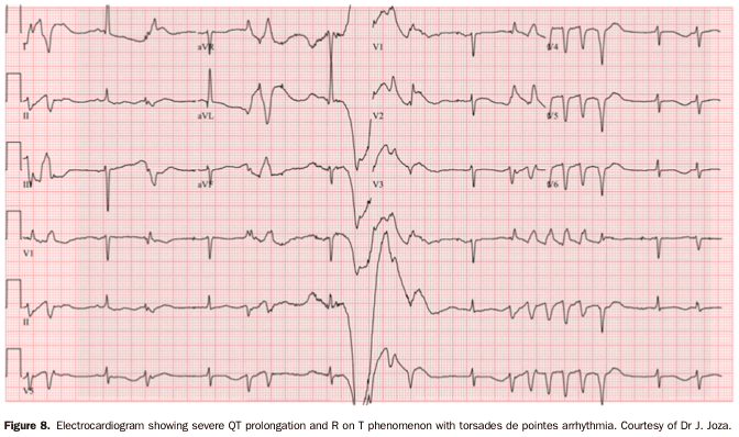 Summary : This figure presents a 12-lead electrocardiogram (ECG) demonstrating severe QT interval prolongation, the R on T phenomenon, and the onset of torsades de pointes arrhythmia.