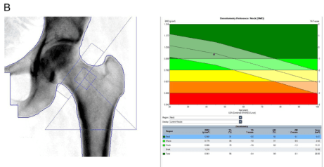 Summary : This figure presents a dual-energy X-ray absorptiometry (DEXA) scan analysis of the proximal femur (hip), including both the scan image and a corresponding bone mineral density (BMD) T-score chart for osteoporosis assessment.
photo and data plot:
# Scan Image :
• Left panel shows a grayscale DEXA scan of the proximal femur (hip joint and upper femur).
• Anatomical landmarks (femoral neck, head, and shaft) are visible.
• Blue rectangular regions of interest (ROIs) are overlaid, demarcating analysis zones (neck, total hip, etc.).
• Additional blue lines outline the femoral contours and analysis boundaries.
# BMD T-score Chart :
• Right panel displays a color-coded reference chart for "Osteometry Reference: Neck (NH)".
• Y-axis: "BMD (g/cm²)" with values from approximately 0.4 to 1.7.
• X-axis: "Age (years)" with values from 20 to 90.
• Colored bands:
– Green (normal BMD)
– Yellow (osteopenia)
– Orange/red (osteoporosis)
• A black data point with error bars marks the patient's BMD value and age.
• Table below the chart lists:
– Region (e.g., "Neck", "Total", "Troch", "Inter", "Ward's", "Shaft")
– BMD (g/cm²), T-score, Z-score, %YAM, %YAM (L), %YAM (R), and other metrics for each region.
# Design Encodings :
• Color bands indicate diagnostic thresholds (green = normal, yellow = osteopenia, orange/red = osteoporosis).
• Black point and error bars show the patient's measurement and uncertainty.
• Blue overlays on the scan image highlight analysis regions.
# Analysis :
• The patient's BMD value is plotted within the color-coded reference, allowing visual assessment of osteoporosis risk.
• The scan and chart together enable anatomical localization and quantitative evaluation.
• The table provides detailed BMD and T-score values for multiple femoral regions, supporting clinical interpretation.