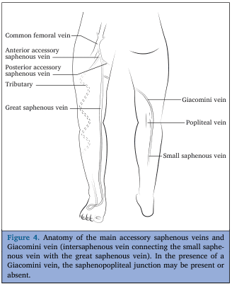 Summary : This anatomical illustration shows the main superficial veins of the lower limb, focusing on the accessory saphenous veins and the Giacomini vein, which connects the small saphenous vein with the great saphenous vein.
illustration:
# Scene Overview :
• Diagram of the posterior and medial aspects of the lower limb, showing the course and connections of major superficial veins.
• Black-and-white line drawing with labeled anatomical structures.
• The left leg is shown from the medial side, and the right leg from the posterior side.
# Technical Details :
• No scale bar or magnification indicated.
• Anatomical labels include: Common femoral vein, Anterior accessory saphenous vein, Posterior accessory saphenous vein, Tributary, Great saphenous vein, Giacomini vein, Popliteal vein, Small saphenous vein.
# Spatial Relationships :
• The great saphenous vein runs along the medial aspect of the leg and thigh, draining into the common femoral vein.
• The small saphenous vein runs along the posterior aspect of the calf, draining into the popliteal vein.
• The Giacomini vein connects the small saphenous vein to the great saphenous vein, running obliquely across the posterior thigh.
• Anterior and posterior accessory saphenous veins branch from the great saphenous vein in the thigh.
# Analysis :
• The illustration highlights the anatomical variability of superficial venous connections in the lower limb, particularly the presence of the Giacomini vein, which may alter the typical drainage pattern at the saphenopopliteal junction.
• The diagram is useful for understanding venous anatomy relevant to clinical procedures and venous insufficiency.