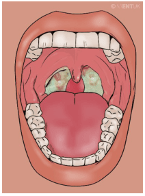 Summary : This illustration shows the inside of a human mouth with a focus on the throat, depicting inflamed tonsils with white-greenish patches, suggestive of tonsillitis or a similar infection.
photo:
Scene Overview :
• Main subject is the open mouth and throat, viewed from the front.
• The tonsils are visibly enlarged and covered with white-greenish exudate.
• The uvula is centered and appears slightly swollen.
• The tongue is prominent in the lower half of the image.
• Teeth are visible along the top and bottom edges of the mouth.
• The background is a solid, muted color, emphasizing the oral cavity.
Technical Details :
• No scale bar or magnification indicated.
• No staining or medical imaging modality used; this is a digital illustration.
• No on-image text except a faint watermark in the upper right corner.
Spatial Relationships :
• Tonsils are located on either side of the uvula, at the back of the throat.
• White-greenish patches are localized to the tonsils, not extending to other oral structures.
• The tongue occupies the foreground, with the throat and tonsils in the background.
Analysis :
• The key visual message is the presence of inflamed, exudate-covered tonsils, which is characteristic of acute tonsillitis or pharyngitis.
• The illustration highlights the typical appearance of infected tonsils, useful for educational or diagnostic reference.