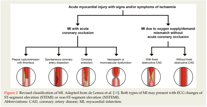 Summary : This flowchart presents a revised classification of myocardial infarction (MI) based on the presence or absence of acute coronary occlusion and the underlying mechanisms, as adapted from de Lemos et al. It visually distinguishes between MI with acute coronary occlusion and MI due to oxygen supply/demand mismatch without acute coronary occlusion, further subdividing each category by specific pathophysiological causes.
flowchart:
# Main Categories :
• Acute myocardial injury with signs and/or symptoms of ischaemia (top-level node).
• Two primary branches:
– MI with acute coronary occlusion.
– MI due to oxygen supply/demand mismatch without acute coronary occlusion.
# MI with Acute Coronary Occlusion (Left Branch) :
• Plaque rupture/erosion with thrombus (circular illustration showing narrowed artery with thrombus).
• Spontaneous coronary artery dissection (circular illustration showing dissection in artery wall).
• Coronary embolism (circular illustration showing embolic obstruction).
• Vasospasm or microvascular dysfunction (circular illustration showing narrowed vessel due to spasm).
# MI Due to Oxygen Supply/Demand Mismatch Without Acute Coronary Occlusion (Right Branch) :
• With fixed obstructive CAD (circular illustration showing narrowed artery with stable plaque).
• Without fixed obstructive CAD (circular illustration showing normal or non-obstructed artery).
# Connectors :
• Downward arrows from the top node to the two main branches.
• Further downward arrows from each main branch to their respective subcategories.
# Layout :
• Hierarchical, top-down structure.
• Two main branches split horizontally, each with multiple subcategories depicted with icons/illustrations.
# Technical Details :
• Figure legend notes that both MI types may present with ECG changes of ST-segment elevation (STEMI) or non-ST-segment elevation (NSTEMI).
• Abbreviations: CAD = coronary artery disease; MI = myocardial infarction.
Analysis :
• The flowchart clarifies that MI can result from either acute coronary occlusion (with several distinct mechanisms) or from an imbalance in oxygen supply and demand without acute occlusion, with or without underlying coronary artery disease.
• Visual icons help differentiate the pathophysiological processes, emphasizing the heterogeneity of MI causes.
• The structure supports clinical differentiation for diagnosis and management.