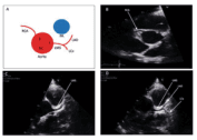 Summary : This figure presents a schematic diagram and three echocardiographic images illustrating the anatomical relationship and visualization of the coronary arteries and aorta.
diagram and echocardiographic images:
# Panel A: Schematic Diagram :
⢠Shows the anatomical relationship between the aorta (red circle) and pulmonary artery (blue circle).
⢠Labels include: RCA (right coronary artery), LMS (left main stem), LAD (left anterior descending), LCx (left circumflex).
⢠Arrows indicate the direction and origin of the coronary arteries from the aorta.
# Panel B: Echocardiographic Image (Short Axis View) :
⢠Displays the aortic root in cross-section.
⢠Labeled structures: RCA (right coronary artery), LMS (left main stem).
⢠The coronary ostia are visible as small openings in the aortic root.
# Panel C: Echocardiographic Image (Short Axis View) :
⢠Similar view as Panel B, focused on the LMS (left main stem).
⢠The LMS is labeled and its origin from the aorta is visualized.
# Panel D: Echocardiographic Image (Long Axis View) :
⢠Shows the aortic root and left ventricle.
⢠Labeled structures: LMS (left main stem), LAD (left anterior descending), LCx (left circumflex).
⢠The course of the coronary arteries is visualized as they branch from the aorta.
# Analysis :
⢠The figure effectively demonstrates the anatomical origins and visualization of the coronary arteries using both schematic and echocardiographic imaging.
⢠The labeled images help correlate anatomical landmarks with ultrasound findings, aiding in the identification of coronary ostia and branches.
⢠No anomalies or abnormal patterns are visible; the images represent typical coronary anatomy.