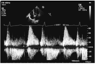 Summary : This figure shows a Doppler echocardiography waveform, specifically a continuous wave (CW) Doppler tracing of blood flow velocities across a cardiac valve, with an inset showing the echocardiographic imaging plane. The image includes measurements of isovolumic relaxation time (IVRT) and displays velocity data over time.
echocardiography waveform:
Title & Axes :
• No explicit title, but the context is a CW Doppler echocardiogram.
• X-axis: Time, with scale bar labeled “100 mm/s” and heart rate “60 bpm”.
• Y-axis: Velocity (cm/s), ranging from -80 to +80 cm/s.
• IVRT (isovolumic relaxation time) is annotated as “92 ms”.
Technical Details :
• Top left: Imaging parameters (FR 45Hz, 18cm, 2D, 59%, C 50, P Off, HGen).
• Top right: Doppler settings (CW, 3.5%, 1.8 MHz, WF 100 Hz).
• Inset: Apical four-chamber echocardiographic view with Doppler cursor placement.
• Grayscale Doppler spectral display with positive and negative velocities.
Waveform Features :
• Multiple cardiac cycles are shown, each with characteristic E and A waves (diastolic filling patterns).
• Baseline at 0 cm/s, with velocities above and below.
• IVRT interval marked between the end of systolic flow and onset of early diastolic filling.
Design Encodings :
• White spectral Doppler tracing on black background.
• Horizontal and vertical grid lines for measurement.
• Annotation arrow and text for IVRT.
Analysis :
• The figure demonstrates typical Doppler velocity patterns across a cardiac valve, with clear E and A waves and a measured IVRT of 92 ms.
• The spectral display allows assessment of diastolic function and timing intervals.
• No obvious arrhythmias or abnormal flow patterns are visible in the waveform.