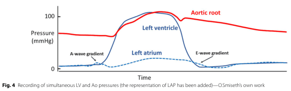 Summary : This figure shows simultaneous pressure recordings from the left ventricle, aortic root, and left atrium over time, illustrating the pressure gradients during the cardiac cycle, including the A-wave and E-wave gradients.
line plot:
Title & Axes :
• No explicit title, but the figure records "simultaneous LV and Ao pressures (the representation of LAP has been added)".
• X-axis: "Time" (no units or tick labels shown).
• Y-axis: "Pressure (mmHg)" with tick marks at 0 and 100.
Data Points :
• Red solid line: "Aortic root" pressure.
• Blue solid line: "Left ventricle" pressure.
• Blue dashed line: "Left atrium" pressure.
• Labeled features: "A-wave gradient" (early rise in left atrial pressure), "E-wave gradient" (later rise in left atrial pressure).
Design Encodings :
• Red solid line for aortic root.
• Blue solid line for left ventricle.
• Blue dashed line for left atrium.
• Labels directly on the plot for anatomical structures and pressure gradients.
Distribution & Trends :
• Aortic root pressure (red) remains above left ventricular pressure during diastole, then both rise sharply and peak during systole, with the left ventricle slightly higher.
• Left atrial pressure (blue dashed) remains low, with small A-wave and E-wave bumps.
• The A-wave and E-wave gradients are marked at the points where left atrial pressure rises relative to the left ventricle.
Analysis :
• The plot demonstrates the normal pressure relationships and timing between the left atrium, left ventricle, and aortic root during the cardiac cycle.
• The A-wave and E-wave gradients highlight the phases of atrial contraction and early ventricular filling, respectively.
• The left ventricle and aortic root pressures closely track each other during systole, with the aortic root pressure remaining slightly lower during the rapid upstroke and slightly higher during the downstroke.
• The left atrial pressure remains much lower than the other two, with characteristic small waves.