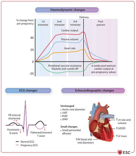 Summary : This figure presents the cardiovascular changes during pregnancy, including haemodynamic, ECG, and echocardiographic changes, with graphical and schematic representations of trends across trimesters, delivery, and postpartum.
line chart and schematic diagram:
# Haemodynamic Changes :
• Line chart showing % change from pre-pregnancy for four parameters: cardiac output, plasma volume, heart rate, and peripheral vascular resistance/diastolic and systolic BP.
• X-axis: Pregnancy timeline (1st trimester, 2nd trimester, 3rd trimester, Delivery, Post-partum).
• Y-axis: % change from pre-pregnancy (range: -20% to +60%).
• Cardiac output: Rises steeply to ~50% above baseline by 2nd trimester, peaks in 3rd trimester, drops sharply at delivery, returns to baseline by 6 weeks postpartum.
• Plasma volume: Rises to ~40% above baseline, peaks in 3rd trimester, drops at delivery, returns to baseline postpartum.
• Heart rate: Rises to ~20% above baseline, peaks in 3rd trimester, drops at delivery, returns to baseline postpartum.
• Peripheral vascular resistance/diastolic and systolic BP: Drops to ~-20% below baseline, lowest in 2nd trimester, rises towards baseline at delivery and postpartum.
# ECG Changes :
• Schematic comparison of normal ECG (black) and pregnancy ECG (purple).
• PR interval shortened in pregnancy.
• Prominent Q wave in pregnancy ECG.
• Flattened/inverted T wave in pregnancy ECG.
# Echocardiographic Changes :
• Schematic heart illustration with labelled changes.
• Unchanged: Aortic root diameter, LVEF (left ventricular ejection fraction), RVEF (right ventricular ejection fraction), SPAP (systolic pulmonary artery pressure).
• Small changes: Small pericardial effusion, increased RV (right ventricular) basal and mid diameters.
• Increased LA (left atrial) size and volume, LVEDD (left ventricular end-diastolic diameter), LV (left ventricular) mass.
# Design Encodings :
• Distinct coloured lines for each haemodynamic parameter.
• Schematic ECG traces with colour-coded changes.
• Heart diagram with labelled anatomical changes.
# Analysis :
• Cardiac output, plasma volume, and heart rate all increase during pregnancy, peaking in the third trimester, and rapidly return to baseline postpartum.
• Peripheral vascular resistance and blood pressure decrease during pregnancy, reaching their lowest in the second trimester, then return to baseline postpartum.
• Pregnancy ECG shows shortened PR interval, prominent Q wave, and flattened/inverted T wave.
• Echocardiographic changes include increased chamber sizes and mass, with most functional parameters unchanged except for small pericardial effusion and increased RV diameters.