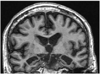 Summary : This image shows a coronal MRI scan of a human brain, displaying anatomical structures in cross-section.
photo:
Scene Overview :
• Main subject is a coronal section of a human brain, as visualized by magnetic resonance imaging (MRI).
• The scan is grayscale, with varying intensities highlighting different tissue types.
• The image is centered on the brain, showing both hemispheres and midline structures.
• The perspective is head-on, with the top of the head at the top of the image.
Technical Details :
• No scale bar or magnification indicator is visible.
• MRI modality, likely T1-weighted due to the contrast between gray and white matter.
• No visible text, UI elements, or annotations on the image.
Spatial Relationships :
• The cerebral cortex is visible around the periphery, with characteristic gyri and sulci.
• The lateral ventricles and third ventricle are visible near the center, appearing as dark spaces.
• The image shows symmetry between the left and right hemispheres.
• The basal ganglia and other deep brain structures are visible below the ventricles.
Analysis :
• The scan provides a clear view of normal brain anatomy, with well-defined cortical and subcortical structures.
• No obvious abnormalities, lesions, or asymmetries are apparent in this image.
• The image is suitable for anatomical study or clinical assessment of brain structure.