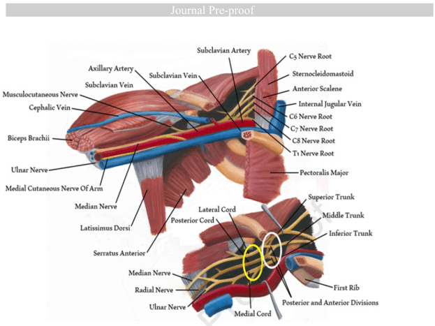 Summary : This anatomical illustration shows the brachial plexus and its relationship to surrounding muscles, arteries, and veins in the upper thoracic and shoulder region. It is a labeled diagram highlighting the major nerves, blood vessels, and muscle groups relevant to the anatomy of the brachial plexus.