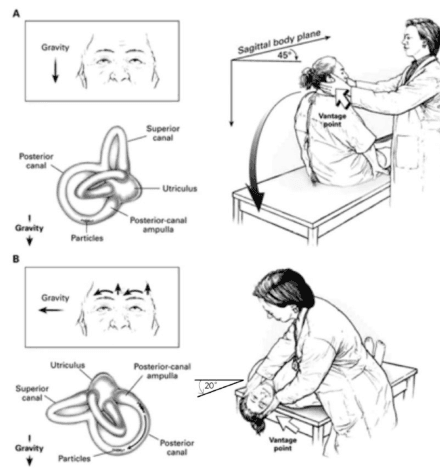 Summary : This figure illustrates the steps and anatomical basis of a clinical maneuver for diagnosing or treating posterior canal benign paroxysmal positional vertigo (BPPV), showing both the head/body positions and the orientation of the inner ear semicircular canals relative to gravity.
illustration:
# Step A : Initial Position and Head Turn
• Patient is seated upright on an examination table.
• Head is turned 45° to the side (sagittal body plane indicated).
• Gravity direction is shown as downward.
• Anatomical diagram of the inner ear highlights the superior canal, posterior canal, utriculus, and posterior-canal ampulla.
• Particles are depicted within the posterior canal, indicating the suspected location of otoconia in BPPV.
# Step B : Reclining Position and Head Extension
• Patient is moved from sitting to a supine position with the head extended backward at a 20° angle.
• Examiner supports the patient’s head at the vantage point.
• Gravity direction is now shown as leftward.
• Anatomical diagram again highlights the superior canal, posterior canal, utriculus, and posterior-canal ampulla.
• Particles remain in the posterior canal, now oriented differently due to the change in gravity direction.
# Spatial Relationships :
• The examiner is positioned behind the patient in both steps, guiding the head movement.
• The vantage point for head support is indicated in both illustrations.
• The anatomical diagrams are aligned with the patient’s head orientation in each step.
# Technical Details :
• No scale bar or magnification is present.
• The angle of head extension (20°) is explicitly labeled.
• The sagittal body plane and gravity vectors are clearly marked.
# Analysis :
• The figure demonstrates how head positioning relative to gravity affects the orientation of the semicircular canals and the movement of particles within the posterior canal.
• The maneuver is designed to provoke or treat vertigo by repositioning otoconia, with each step altering the gravitational vector acting on the inner ear structures.
• The anatomical diagrams clarify the rationale for the head movements in the clinical procedure.