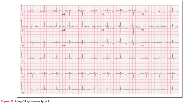 Summary : This figure presents a 12-lead electrocardiogram (ECG) tracing from a patient with Long QT syndrome type 2, illustrating the characteristic prolonged QT interval.
ecg tracing:
# Leads & Layout :
• Standard 12-lead ECG format: I, II, III, aVR, aVL, aVF, V1–V6.
• Each lead is displayed in a horizontal row, with time progressing left to right.
• Vertical grid lines represent time intervals (small squares = 0.04 s, large squares = 0.2 s).
# Key Features :
• Regular sinus rhythm is present.
• QT interval is visibly prolonged in multiple leads (notably V2–V5).
• T waves are broad and notched in some leads, consistent with Long QT syndrome type 2.
• No evidence of acute ischemia, bundle branch block, or significant arrhythmia.
# Technical Details :
• Paper speed: standard 25 mm/s.
• Amplitude: standard 10 mm/mV.
• Calibration marker visible at the start of each lead row.
# Analysis :
• The ECG demonstrates a prolonged QT interval, a hallmark of Long QT syndrome type 2.
• T wave morphology (broad, notched) is typical for this subtype.
• No other acute abnormalities are apparent; the tracing is otherwise unremarkable except for the QT prolongation.