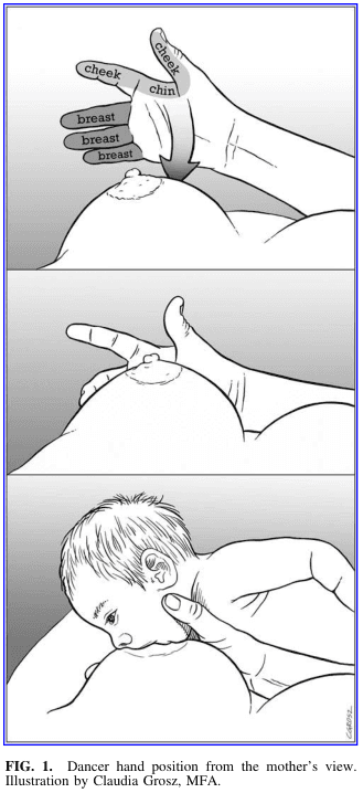 Summary : This illustration demonstrates the "dancer hand position" technique for breastfeeding, as viewed from the mother's perspective. The figure consists of three panels showing the step-by-step hand placement and support for effective latch and feeding.
illustration:
# Scene Overview :
• The main subject is a mother’s hand supporting her breast and the infant’s head during breastfeeding.
• The perspective is from the mother’s viewpoint, focusing on the hand, breast, and infant.
• The illustration is in grayscale, with clear anatomical labeling in the top panel.
# Technical Details :
• No scale bar or magnification is present.
• The top panel labels anatomical landmarks: "cheek," "chin," and "breast."
• The hand is shown with fingers supporting the breast and the thumb positioned near the infant’s cheek and chin.
• The middle panel shows the hand maintaining support as the infant approaches the breast.
• The bottom panel depicts the infant latched onto the breast, with the mother’s hand still in the dancer position.
# Spatial Relationships :
• The hand is consistently placed under the breast, with the thumb and fingers providing support and gentle pressure.
• The infant’s head is cradled by the mother’s hand, ensuring alignment of the chin and cheek with the breast for optimal latch.
• The sequence moves from preparation (top), approach (middle), to active feeding (bottom).
# Analysis :
• The illustration visually instructs on the dancer hand position, emphasizing anatomical alignment and support for successful breastfeeding.
• The stepwise depiction clarifies the technique, showing how the hand stabilizes both the breast and the infant’s head to facilitate feeding.
• The labeled anatomical points guide correct finger placement for mothers learning this method.