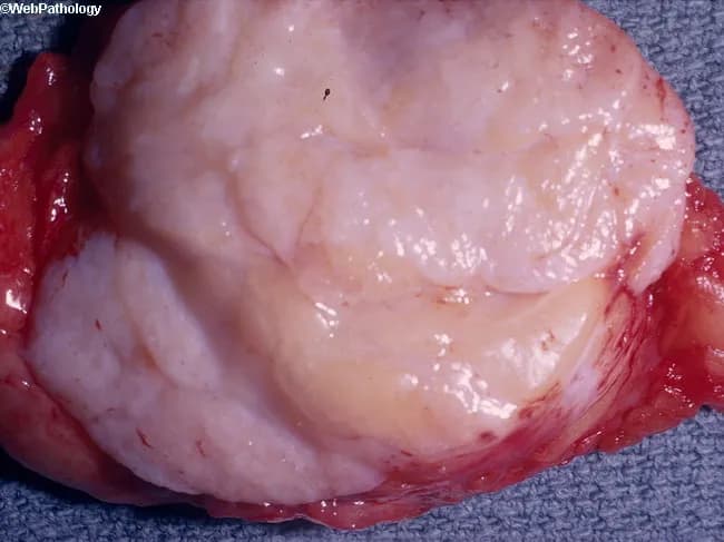 This is a macroscopic photograph of a surgically excised breast mass consistent with a fibroadenoma. Modality and Technique: gross pathology photography of a breast lesion; specimen is opened to expose the cut surface. Location and Anatomical Context: breast parenchyma derived from terminal duct-lobular units; the mass resides within the fibrous breast stroma. Visual features: small, well-demarcated, firm, grayish-pink nodule with a bulging, whorled cut surface; smooth, glistening capsule; homogenous pale color; margins appear noninfiltrative. Notable pathology indicators: the gross appearance reflects biphasic epithelial and stromal proliferation typical of fibroadenoma; microscopic confirmation would demonstrate compressed ducts embedded in fibrous stroma with pericanalicular or intracanalicular patterns (not visible on this image). Diagnostic significance: a classic benign breast tumor with well-defined margins; should be distinguished from phyllodes tumor, fibrocystic change, or malignancy through histology and correlation with imaging. Clinical relevance and use cases: common in reproductive-age women; management usually conservative observation or local excision if symptomatic; imaging correlation with ultrasound or mammography enhances diagnostic confidence; this image serves educational demonstration of gross morphology and surgical pathology. The specimen’s color and texture align with benign stromal-epithelial interactions; radiologic-pathologic concordance supports routine follow-up; prompt recognition reduces unnecessary alarm and guides patient counseling and clinical decision-making.