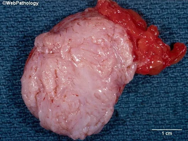 Gross pathology photograph of a breast fibroadenoma. The specimen is a well-circumscribed, firm, pale-tan mass with a smooth surface; surrounding adipose tissue is visible. The cut surface shows lobulated architecture and slit-like spaces consistent with fibroepithelial tumor morphology. Necrosis is not present on gross examination. The lesion measures several centimeters in greatest dimension; a 1 cm scale bar is provided for reference. Histologically, this entity demonstrates biphasic fibroepithelial tissue with a dense fibrous stroma interlacing with benign ductal epithelium, often arranged in compressed or intracanalicular patterns; there is no appreciable cytologic atypia or mitotic activity. Clinically, fibroadenomas are common benign breast tumors in young women, with median age around 25 years and mean age near 30; they typically present as firm, mobile, non-tender masses. Diagnostic significance rests on distinguishing benign fibroadenoma from phyllodes tumor and fibrocystic change; absence of necrosis and orderly architecture support benignity. Differential considerations include phyllodes tumor (benign or malignant), fibrocystic change, adenosis, and ductal hyperplasia. This image is valuable for pathology education, breast disease databases, and radiopathologic correlation studies. Potential clinical applications: teaching gross-pathology correlations, reinforcing macroscopic-histologic relationships, and aiding differential diagnosis for palpable breast masses in premenopausal patients. Useful for examiners, clinicians, researchers, and students.