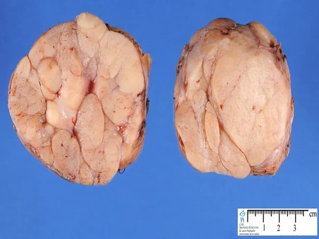 Gross pathology photograph of a bilateral breast fibroadenoma specimen. The two lobulated masses are ex vivo and oriented for frontal viewing, with a clean, pale tan to light pink cut surface. The surface exhibits a multi‑lobulated architecture, with a firm, rubbery consistency and some fibrous septations separating nodular lobules. Each mass measures approximately 2–3 cm in greatest dimension, as estimated against the centimeter scale visible at the lower right. The margins are well circumscribed without overt invasion or necrosis. The lesions are benign fibroepithelial tumors consisting of stromal and epithelial components, and the cut surface is relatively homogeneous, lacking significant hemorrhage. This gross appearance is classic for fibroadenoma, particularly in young or middle‑aged patients, and may be bilateral. Clinically, fibroadenomas present as non tender, mobile breast lumps and often prompt surgical excision for definitive diagnosis. Radiologic correlation can show well circumscribed, oval lesions with smooth margins on ultrasound or mammography. Histologic confirmation is recommended to distinguish fibroadenoma from phyllodes tumor, especially in larger or rapidly growing masses. The image supports diagnostic consideration of benign breast disease and can be used for education, comparison with gross findings, and teaching gross pathology technique. This specimen demonstrates lobulated morphology and firm, well‑circumscribed margins.