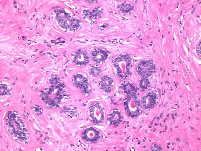 Histology: breast fibroepithelial lesion evaluated by light microscopy after Hematoxylin and Eosin staining. The specimen demonstrates tubular and glandular elements embedded in a fibrous loose stroma. Ducts and glands are lined by a bilayered epithelium composed of cuboidal to low columnar cells with uniform, bland nuclei. A continuous myoepithelial cell layer surrounds the tubules, supporting a benign biphasic architecture typical of a fibroadenoma. The stroma is predominantly loose connective tissue, with sparse to moderate cellularity and no overt stromal overgrowth. No prominent leaf-like stromal projections, mitotic figures, or cytologic atypia are evident within the epithelium or stroma. This combination of ductal epithelial proliferation with intact myoepithelial lining and a nonproliferative stroma favors a benign fibroepithelial lesion rather than a phyllodes tumor. The diagnostic significance rests on stromal characteristics: hypercellular stroma with progressive stromal overgrowth and leaf-like architecture would point toward phyllodes; absence of these features supports fibroadenoma. Clinically, these findings correlate with a small, mobile breast mass commonly seen in young to middle-aged women and may be managed conservatively or with excisional biopsy depending on size, growth, and patient preference. Immunohistochemistry for myoepithelial markers (e.g., p63, smooth muscle actin) can aid confirmation when needed.