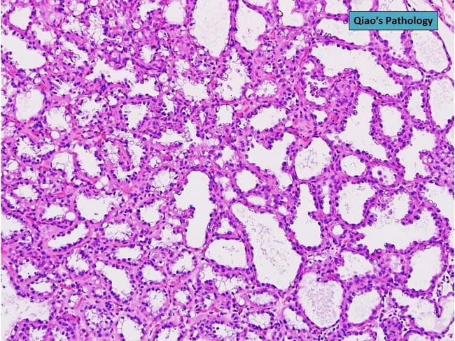 This is a histopathologic slide of the lactating breast illustrating a lactating adenoma. Imaging modality: Light microscopy of Hematoxylin and Eosin stained tissue section. The lesion shows multiple hyperplastic lobules within the breast parenchyma, with preserved lobular architecture. The luminal surfaces reveal actively secreting cuboidal to columnar epithelial cells, containing abundant eosinophilic cytoplasm and apical secretions, consistent with milk production. The stroma is mildly fibrous, with sparse inflammatory infiltrates and no significant atypia or mitotic activity. Ductal and acinar structures appear dilated, filled with secretory material, giving a benign, well-circumscribed, nodular appearance. Overall, features are classic for a lactating adenoma: a hormonally driven, benign lesion arising during pregnancy or lactation that mimics other secretory breast lesions but lacks malignant cytology. Diagnostic significance: distinguishes benign lactational changes from mastitis, fibroadenoma, or carcinoma; clinical correlation with recent pregnancy/breastfeeding supports diagnosis. Differential considerations include fibroadenoma with lactational change, secretory carcinoma (rare), and puerperal mastitis. This image is suitable for educational purposes in surgical pathology, breast disease, lactation-related breast lesions, and differential diagnosis of palpable breast masses in postpartum women. Potential clinical use cases: undergraduate/graduate medical education, residency training, and research on lactational breast pathology. These features confirm benign lactational physiology and correlate clinically.