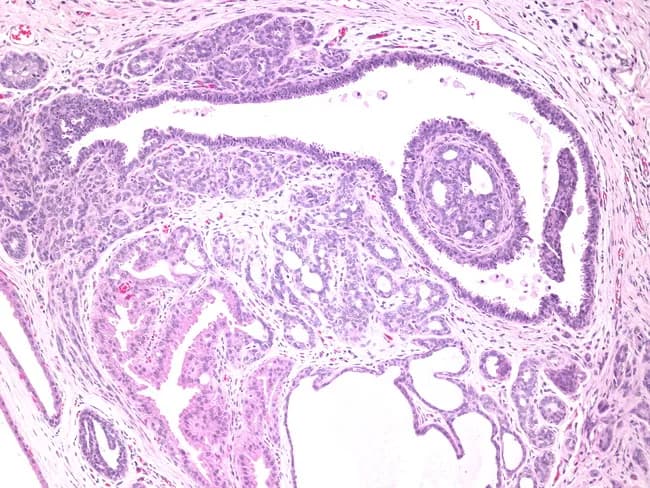 Histology: Light microscopy of a breast tissue section stained with Hematoxylin and Eosin (H&E). A dilated lactiferous duct is the central focus, showing a prominent intraductal papilloma with a delicate fibrovascular core. The papillary stalks project into the ductal lumen and are lined by two cell layers: inner luminal epithelium and an outer myoepithelial layer, consistent with a benign intraductal process. The epithelium exhibits uniform cuboidal to columnar cells without significant cytologic atypia or mitotic activity. Surrounding the dilated duct are fibrocystic changes, including stromal fibrosis and scattered cystic dilatations with mucinous or apocrine metaplasia. The overall architecture remains organized, with no invasion into the surrounding stroma. Basally oriented myoepithelial cells are preserved, supporting benignity. The features differentiate intraductal papilloma from papillary ductal carcinoma in situ, where myoepithelial absence and cellular atypia would be more evident. Clinically, such lesions can present with occasional nipple discharge and are typically managed with conservative surgical excision when symptomatic. The image provides a representative example of a recurring benign papillary duct lesion within a dilated duct and accompanying fibrocystic breast parenchyma, underscoring the importance of recognizing papillary architecture, mucinous luminal contents, and the protective myoepithelial layer in diagnostic practice. For educational use and clinical correlation.