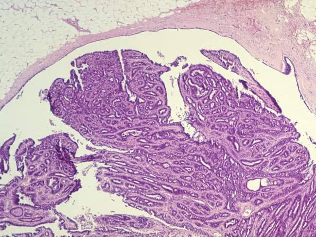Imaging modality: Light microscopy of hematoxylin and eosin (H&E) stained breast tissue section illustrating a palpable intraductal papilloma. The lesion measures 2.1 cm in greatest dimension, consistent with a solitary ductal papilloma within a lactiferous duct. The histology reveals papillary architecture with fibrovascular cores projecting into ductal lumens. Each papillary frond is lined by a two-layered epithelium comprising an inner luminal epithelial cell layer and an outer myoepithelial cell layer, a characteristic feature distinguishing benign papillary lesions from invasive carcinoma. Ductal epithelium displays mild hyperplasia without overt cytologic atypia; no invasion of surrounding stroma is evident. The ducts appear distended with a mild fibrous stroma and occasional periductal inflammation. The presence of preserved myoepithelial mantle supports benignity. The overall pattern is nodular, with elongated papillae and a fibrous stroma backdrop. Pathologic significance: benign breast lesion that can explain a clinically palpable mass and possibly nipple discharge. Diagnostic considerations include solitary intraductal papilloma with or without epithelial hyperplasia, papillomatosis, and radiologically occult microcalcifications. Clinical relevance: complete excision is often curative; follow-up recommended to exclude atypia or malignant transformation in broader ductal pathology. This image is educational for pathology, breast disease differential diagnosis, and surgical planning. Useful for teaching, research, and reviews.