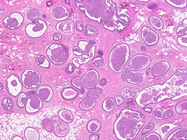 Imaging modality: Light microscopy of Hematoxylin and Eosin stained thyroid tissue. The section displays a diffuse, multilocular thyroid parenchyma with numerous round to oval follicles of varying diameter. Follicles are lined by a single layer of cuboidal to flattened epithelium, separating abundant eosinophilic colloid within expansive lumens. The colloid appears as homogenous pink material; some follicles are dilated with scant luminal epithelium, while others are more compact, creating a cobblestone-like appearance. The surrounding stroma is minimally fibrous, with occasional vascular spaces and sparse interfollicular connective tissue. There is no evident cellular atypia or overt inflammatory infiltrate in this field. Overall architecture shows a benign-appearing follicular pattern with preserved polarity and uniform follicle distribution, though follicle sizes vary, suggesting a multinodular or hyperplastic process. The image illustrates classical thyroid histology, showcasing normal thyroid parenchyma or a mild nodular change characterized by colloid-rich follicles. Diagnostic significance lies in identifying thyroid tissue with intact colloid-filled follicles, helping to differentiate benign thyroid tissue from neoplastic lesions such as follicular adenoma or follicular carcinoma when clinical data and adjunct studies are available. This image is applicable for educational demonstrations of thyroid histology, goiter pathology, and comparative endocrine pathology.