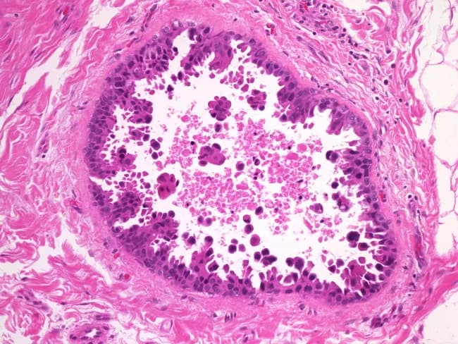 This image depicts a hematoxylin and eosin stained breast tissue section examined by bright-field light microscopy, highlighting micropapillary ductal carcinoma in situ (DCIS). The lesion shows micropapillary architecture with papillary fronds projecting into the duct lumen. Papillary elements range from small bumps or mounds to slender, elongated fronds; in several instances the fronds are transected, creating small detached irregular clusters of tumor cells. The intraductal space contains scattered cellular debris, a feature associated with higher-grade disease. The tumor cells exhibit high nuclear grade, characterized by enlarged, hyperchromatic nuclei and conspicuous nucleoli within a compact epithelial lining. The surrounding tissue shows a distinct ductal distribution without obvious stromal invasion in this field, consistent with an in situ process rather than invasive carcinoma. The micropapillary pattern may be linked to increased risk of local recurrence and challenges in complete excision, underscoring the need for meticulous histologic sampling to exclude invasion. Clinically, recognizing this variant informs prognosis and treatment planning in breast cancer, including surgical margins, adjuvant therapy considerations, and radiologic correlation for residual disease. This image serves educational and research purposes, illustrating the micropapillary DCIS subtype and its distinguishing morphologic features for pathologists, residents, and students.
