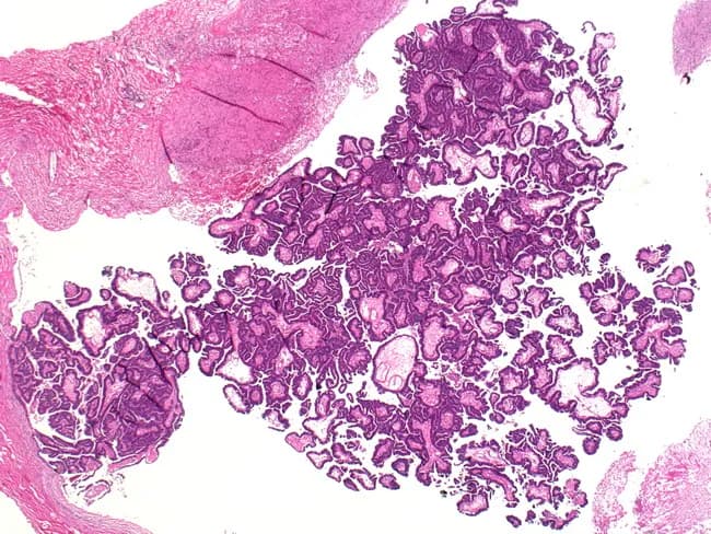 This histopathology image depicts a breast lesion consistent with encapsulated intracystic papillary carcinoma. Stained with Hematoxylin and Eosin and examined under light microscopy at multiple magnifications (4x–40x), the lesion is sharply circumscribed within a dilated duct, producing a mural nodule projecting into a cystic space. Papillary architecture is evident, with slender fibrovascular cores lined by neoplastic epithelium. The epithelial layer is typically bland, with low to intermediate cytologic grade and minimal mitotic activity; myoepithelial cells may be present around the papillary fronds in in-situ-appearing regions, while invasive foci, when present, disrupt the capsule and show irregular infiltration. The capsule is fibrous and distinct from surrounding ductal tissue. In some samples, accompanying DCIS or invasion is limited to the pericapsular region, correlating with clinical reports that encapsulated papillary carcinoma often follows an indolent course but may harbor an invasive component. Immunophenotype often shows variable estrogen and progesterone receptor positivity with variable HER2 status. Clinically, this entity occurs in older women and carries a favorable prognosis after complete excision. Differential considerations include intraductal papilloma, mucinous carcinoma, and invasive papillary carcinoma without an encapsulating border. The image highlights the need to assess invasion, capsule integrity, and ductal architecture for accurate diagnosis and treatment planning.