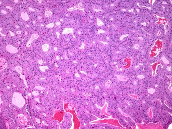 Breast tissue histology prepared as a formalin-fixed paraffin-embedded section stained with hematoxylin and eosin and examined by light microscopy. The specimen represents mammary parenchyma with ducts exhibiting papillary architecture consistent with papillary carcinoma; within several ducts there is apocrine metaplasia characterized by tall columnar cells with abundant eosinophilic granular cytoplasm and prominent apical snouts. The papillary fronds display fibrovascular cores, and the epithelial lining shows mild cytologic atypia without conspicuous mitotic activity in the field. The stroma is fibrous with scattered periductal lymphocytes; luminal spaces contain variable secretions. The differential diagnosis includes benign intraductal papilloma versus papillary carcinoma with apocrine differentiation; recognition of apocrine features is important to avoid misinterpretation as benign changes and to guide further workup. Clinically, papillary lesions of the breast require correlation with imaging and receptor studies; apocrine differentiation may be seen in older patients and can influence immunohistochemical profiling, including androgen receptor expression. This image is pertinent for education on breast tumor histopathology and serves as a reference for pathology residents, fellows, and radiology–pathology correlation cases. Potential applications include diagnostic training, differential diagnosis exercises, and quality assurance reviews in breast pathology. Correlation with gross findings and imaging enhances diagnostic confidence.